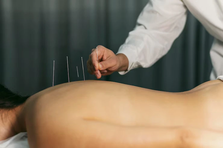 acupuncture-process_23-2148824045 (1)